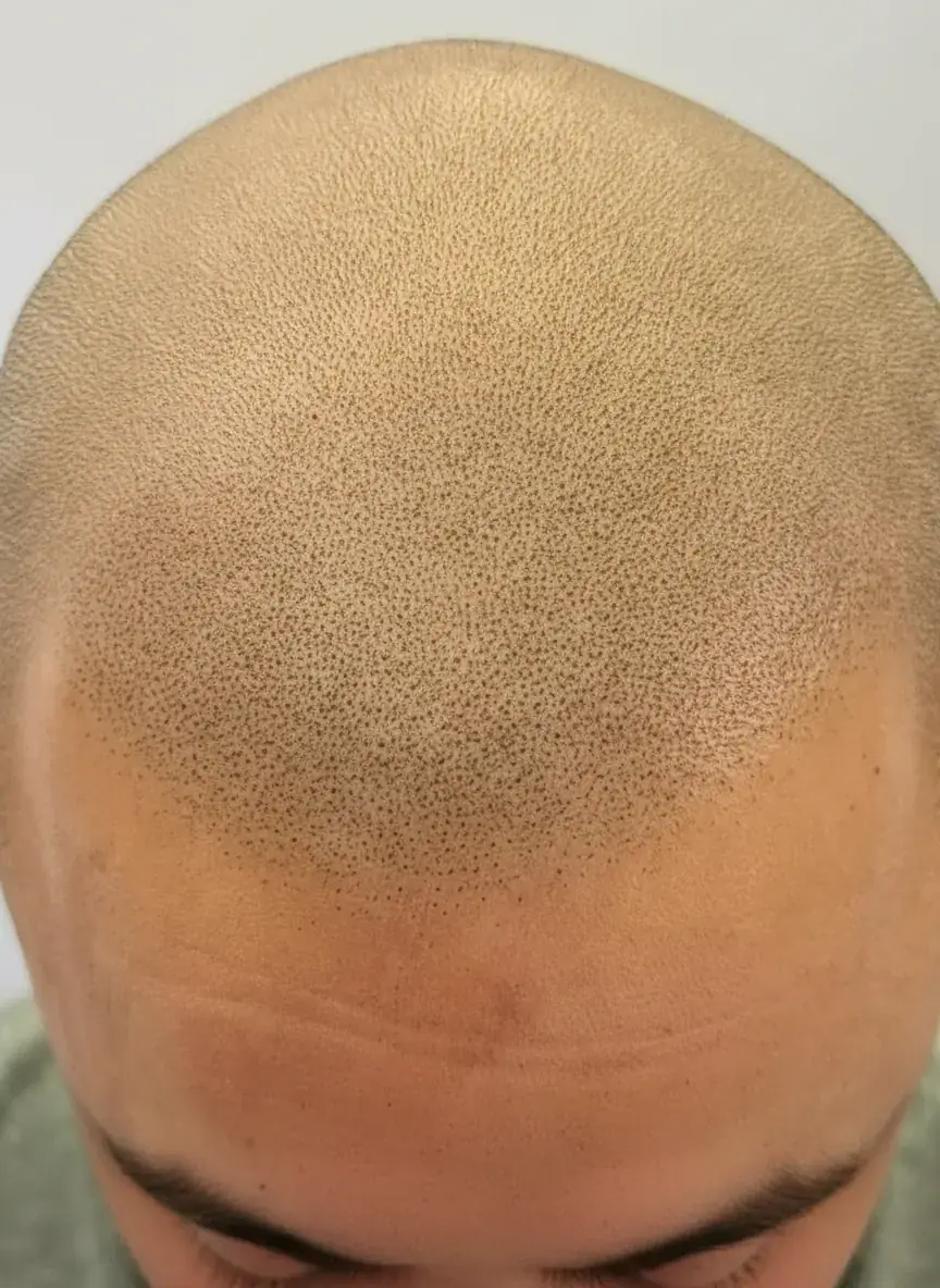 After hair transplant scar concealment smp palm beach county wellington fl